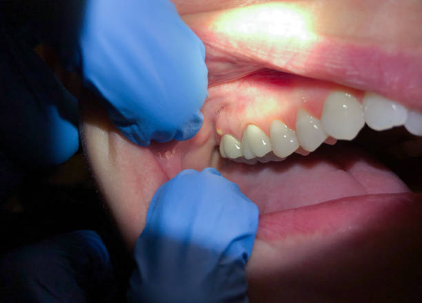 Best Chipped Tooth Repair Near Me  in Thorntown, IN